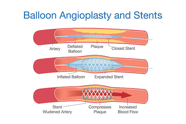 ilustraciones, imágenes clip art, dibujos animados e iconos de stock de globo angioplastia y sstents procedimiento - angioplasty