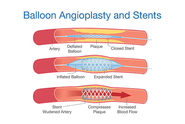 баллонную ангиопластику и sstents процедуры - open vial stock illustrations