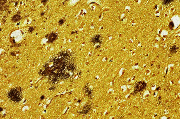 현미경 뇌 조직 (alzheimer's 질병 - 마이크로글리아 뉴스 사진 이미지
