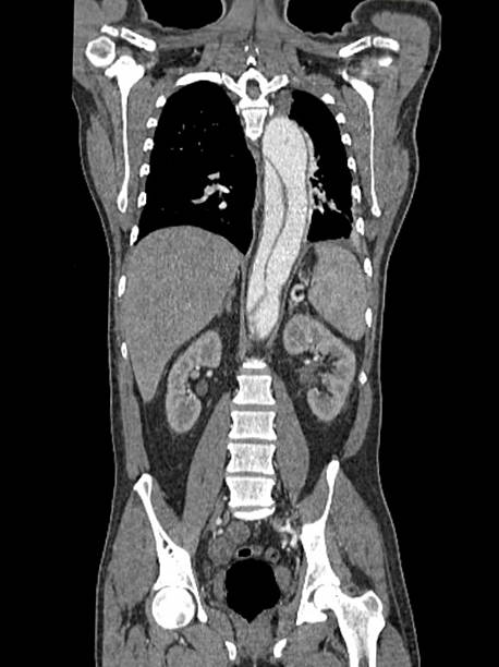 aortic dissection 컴퓨터 단층촬영 스캔 - dissection 뉴스 사진 이미지