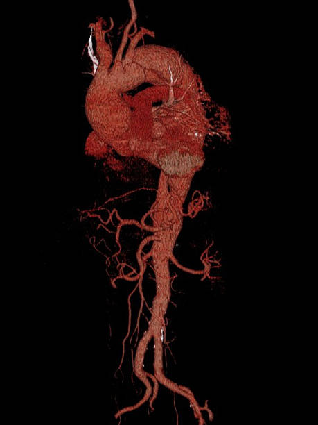 istock 3D computed tomography reconstruction of the heart and aorta 531106909