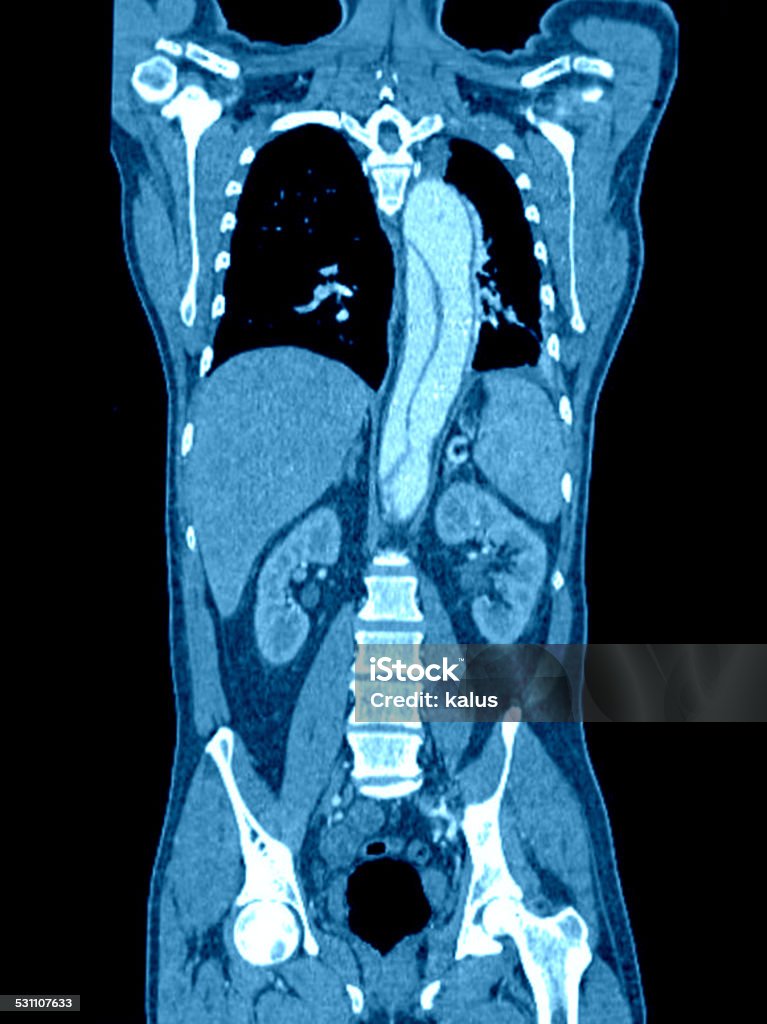 Aortic dissection on computed tomography scan Aortic dissection is a life-treating disease requiring high-risk urgent surgery Aorta Stock Photo