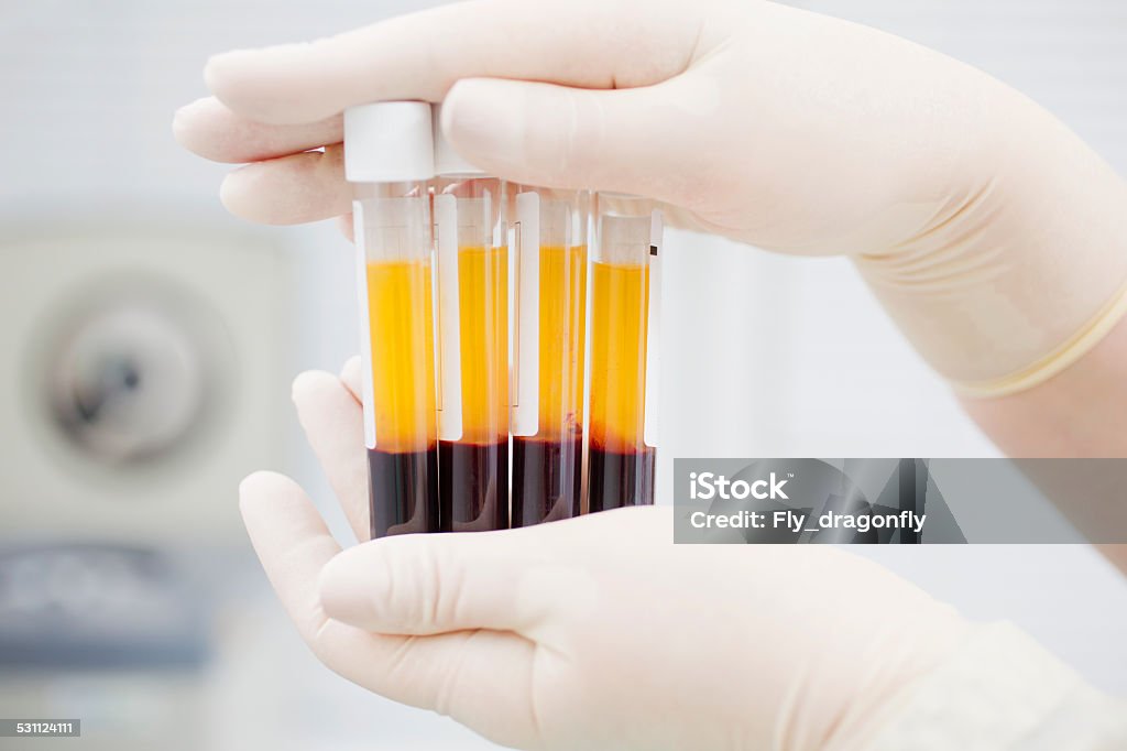 Preparing blood for Plasmolifting. Blood tubes in two layers divided by centrifuge after. cosmetic manipulation Blood Plasma Stock Photo