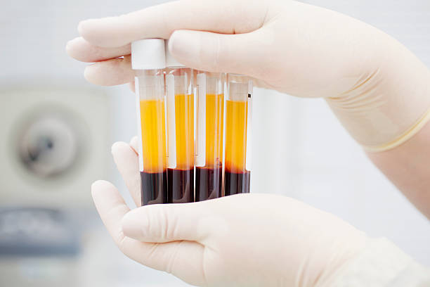Preparing blood for Plasmolifting. Blood tubes in two layers divided by centrifuge after. cosmetic manipulation blood plasma stock pictures, royalty-free photos & images