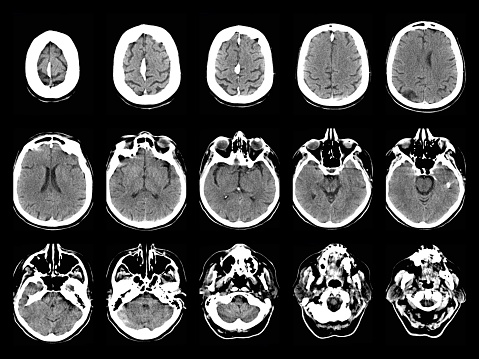 Accidente cerebrovascular en CT photo