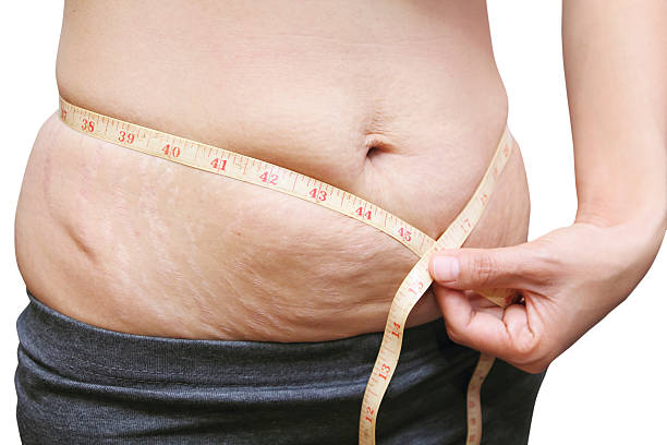 istock stretch marks on Asian woman belly 531164945