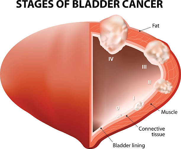 cancer bladder cancer bladder. Diagram showing the stages of bladder cancer. Human anatomy bladder stock illustrations