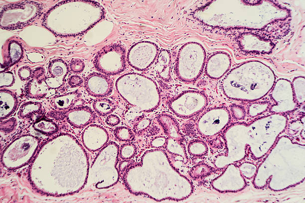 fibrocystic ändern (krankheit) der brust - wissenschaftliche mikroskopische aufnahme stock-fotos und bilder