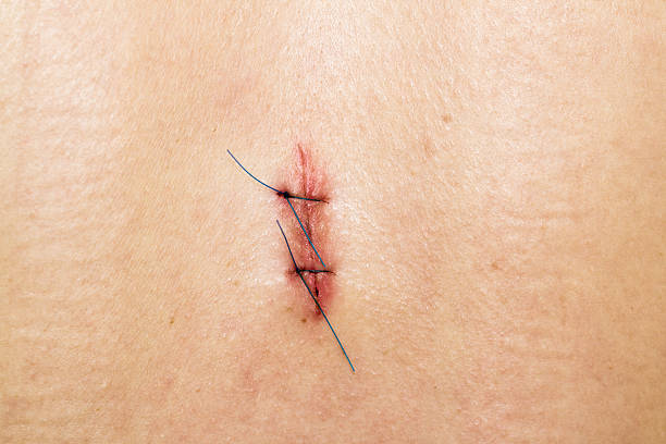 Skin Stiches Close-up shot of a small scar with stiches. scar surgery rear view human spine stock pictures, royalty-free photos & images