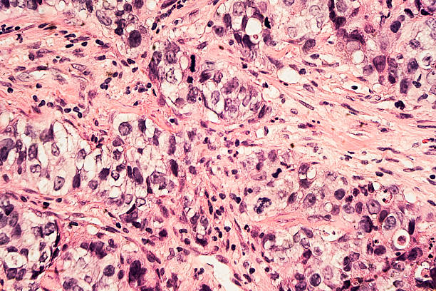 Breast Cancer: Invasive Ductal Carcinoma, Grade 3 Breast cancer: Microscopic image of a poorly differentiated, grade 3, infiltrating (invasive) ductal carcinoma (photographed and uploaded by US board-certified surgical pathologist). adenocarcinoma photos stock pictures, royalty-free photos & images