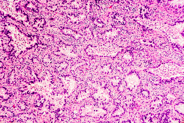 cáncer de pulmón : adenocarcinoma - micrografía de luz fotografías e imágenes de stock