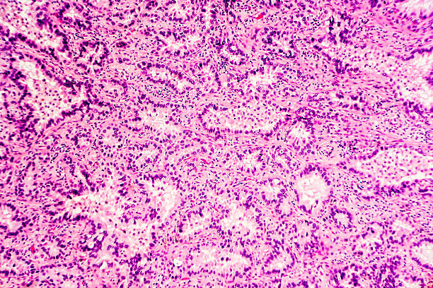 Lung Cancer: Adenocarcinoma Lung cancer - adenocarcinoma: Therapies targeting specific genetic alterations such as EGFR, ALK and ROS1 are appropriate for selected cases (photographed and uploaded by US surgical pathologist). light micrograph stock pictures, royalty-free photos & images