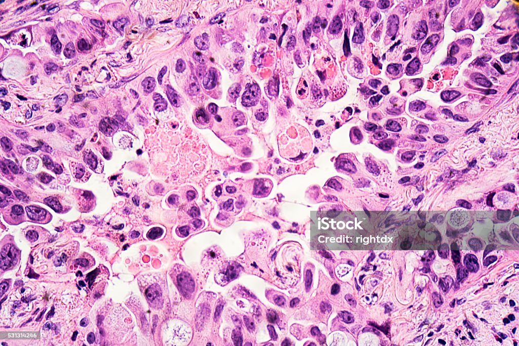 Lung Cancer: Adenocarcinoma Lung cancer - adenocarcinoma: Therapies targeting specific genetic alterations such as EGFR, ALK and ROS1 are appropriate for selected cases (photographed and uploaded by US surgical pathologist). Cancer Cell Stock Photo