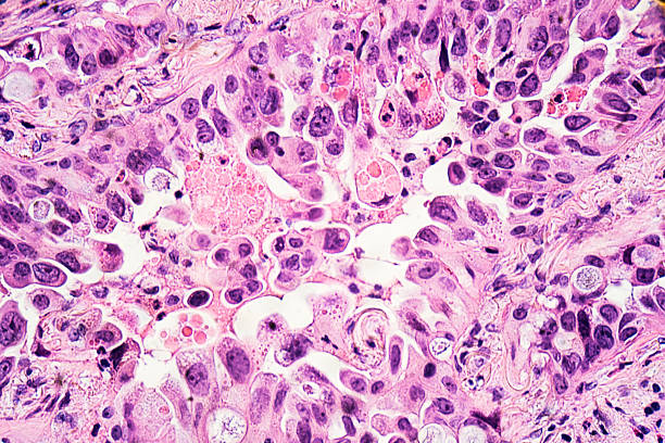 Lung Cancer: Adenocarcinoma Lung cancer - adenocarcinoma: Therapies targeting specific genetic alterations such as EGFR, ALK and ROS1 are appropriate for selected cases (photographed and uploaded by US surgical pathologist). scientific micrograph stock pictures, royalty-free photos & images