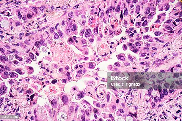Lung Cancer Adenocarcinoma Stock Photo - Download Image Now - Cancer Cell, Cancer - Illness, Microscope