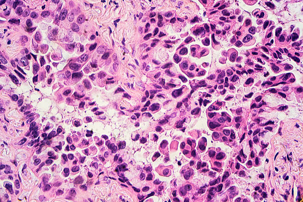 Lung Cancer: Adenocarcinoma Lung cancer - adenocarcinoma: Therapies targeting specific genetic alterations such as EGFR, ALK and ROS1 are appropriate for selected cases (photographed and uploaded by US surgical pathologist). adenocarcinoma photos stock pictures, royalty-free photos & images