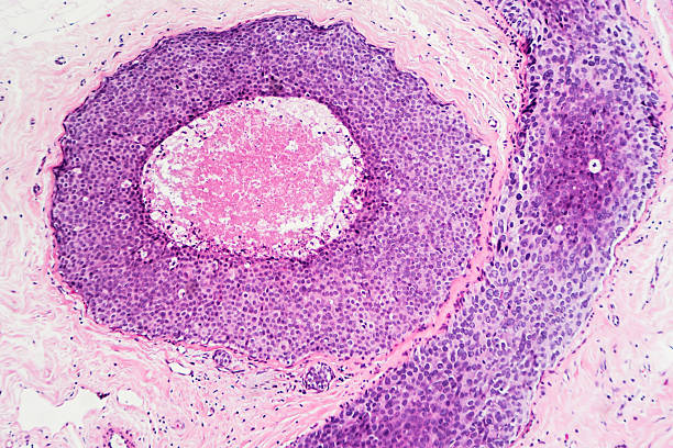 Breast Cancer: DCIS Breast cancer - ductal carcinoma in situ (DCIS): Tumor cells are confined to the mammary ducts. No invasion is seen (photographed and uploaded by US board certified surgical pathologist). microscope slide stock pictures, royalty-free photos & images