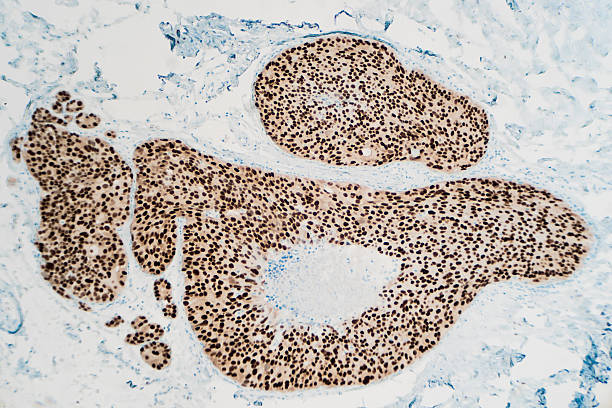 乳がん：免疫組織化学 - high scale magnification magnification cell scientific micrograph ストックフォトと画像