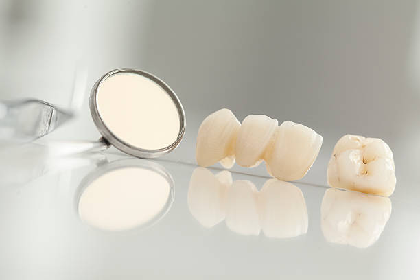 Ceramic bridge close up view Ceramic bridge close up view dental crown stock pictures, royalty-free photos & images