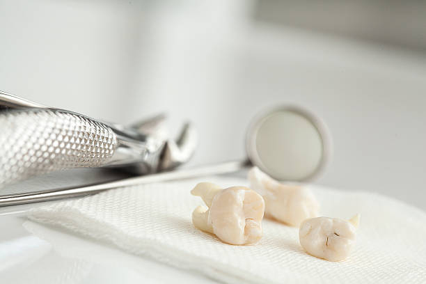 removed wisdom tooth on white - teeth stockfoto's en -beelden