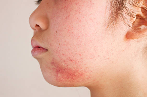istock Inflammation of skin 531370019