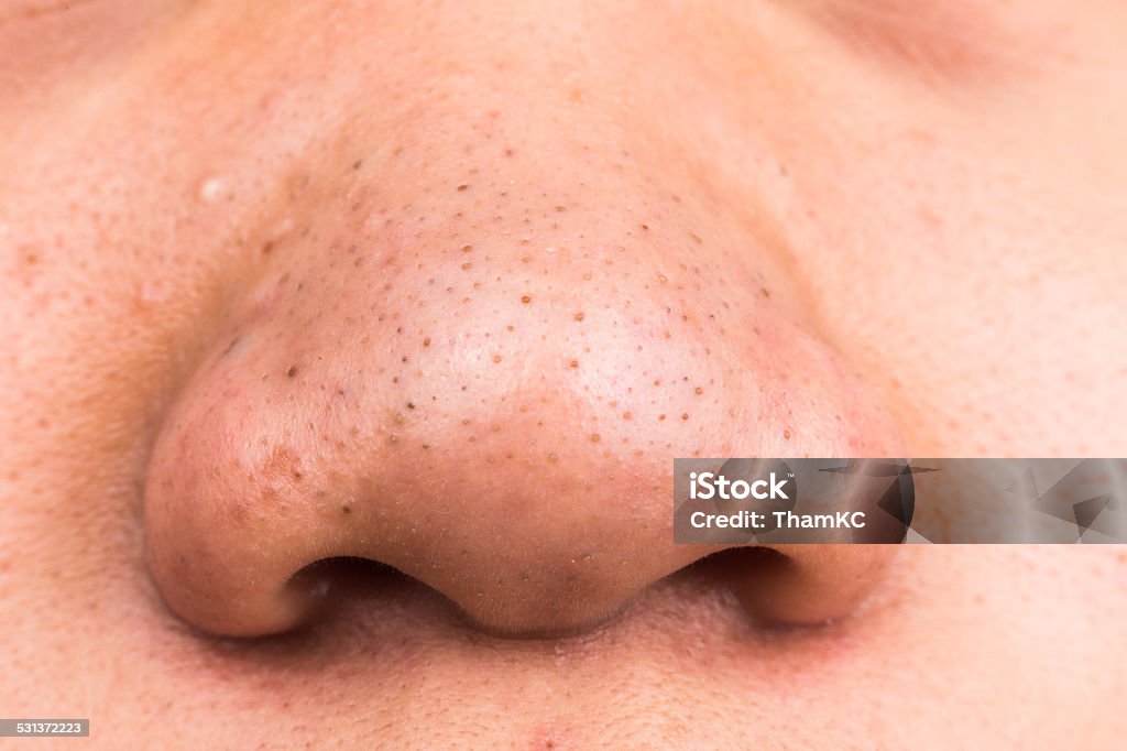 Closed up of pimple blackheads on nose Closed up of pimple blackheads on nose of a teenager Asian and Indian Ethnicities Stock Photo