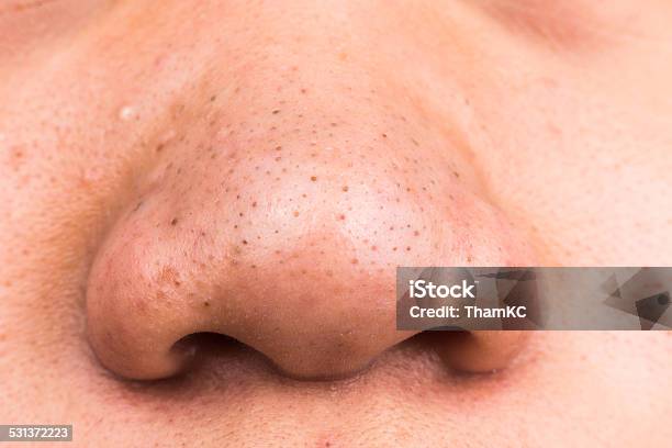 Closed Up Of Pimple Blackheads On Nose Stock Photo - Download Image Now - Asian and Indian Ethnicities, Human Face, Human Nose