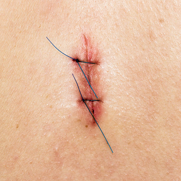 Skin Stiches Close-up shot of a small scar with two stiches. scar surgery rear view human spine stock pictures, royalty-free photos & images