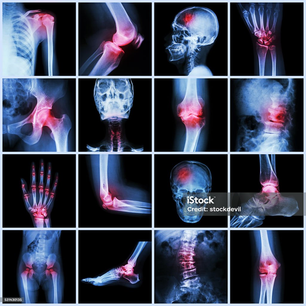 Collection human joint and arthritis and stroke Collection human joint and arthritis and stroke ( skull head neck shoulder chest thorax shoulder arm elbow forearm wrist hand finger palm spine back pelvis thigh knee leg foot ankle toe) The Human Body Stock Photo