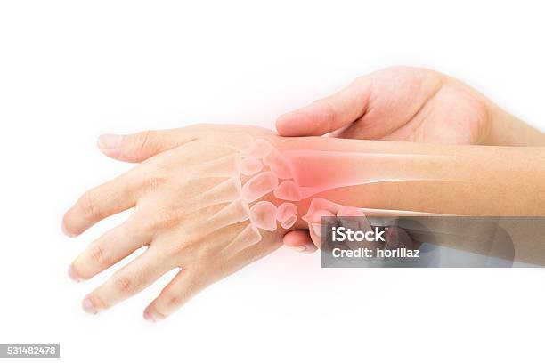 Wrist Bones Injury Stock Photo - Download Image Now - Pain, Wrist, Tendinopathy