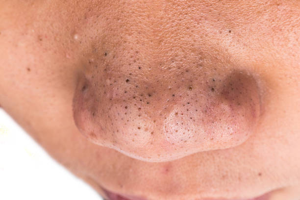 закрыть up of пятно blackheads on the nose - нос человека стоковые фото и изображения