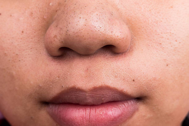 istock Pimple blackheads on the nose and lips 531522499