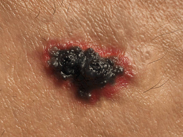 Skin cancer UV light can cause mutations in the DNA and induce skin cancer. metastasis photos stock pictures, royalty-free photos & images