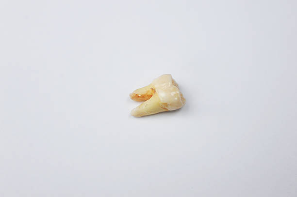Extracted Tooth stock photo