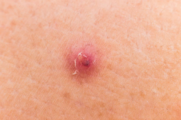 istock Closed up of blemish on the shoulder 531655919
