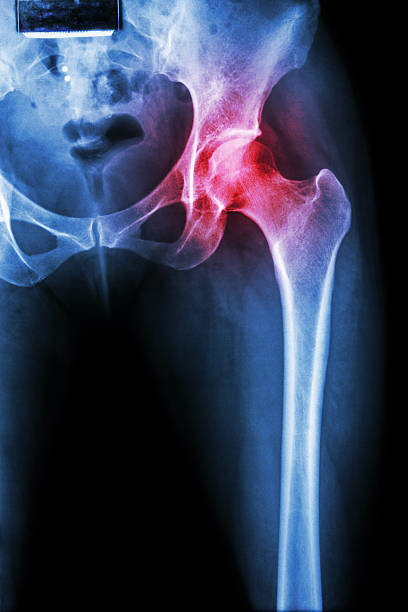 artritis de la cadera común - haunch fotografías e imágenes de stock