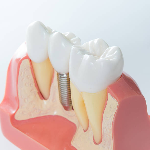 istock Dental implant 531900783