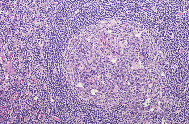 Reactive follicular hyperplasia (RFH) in lymph nodes