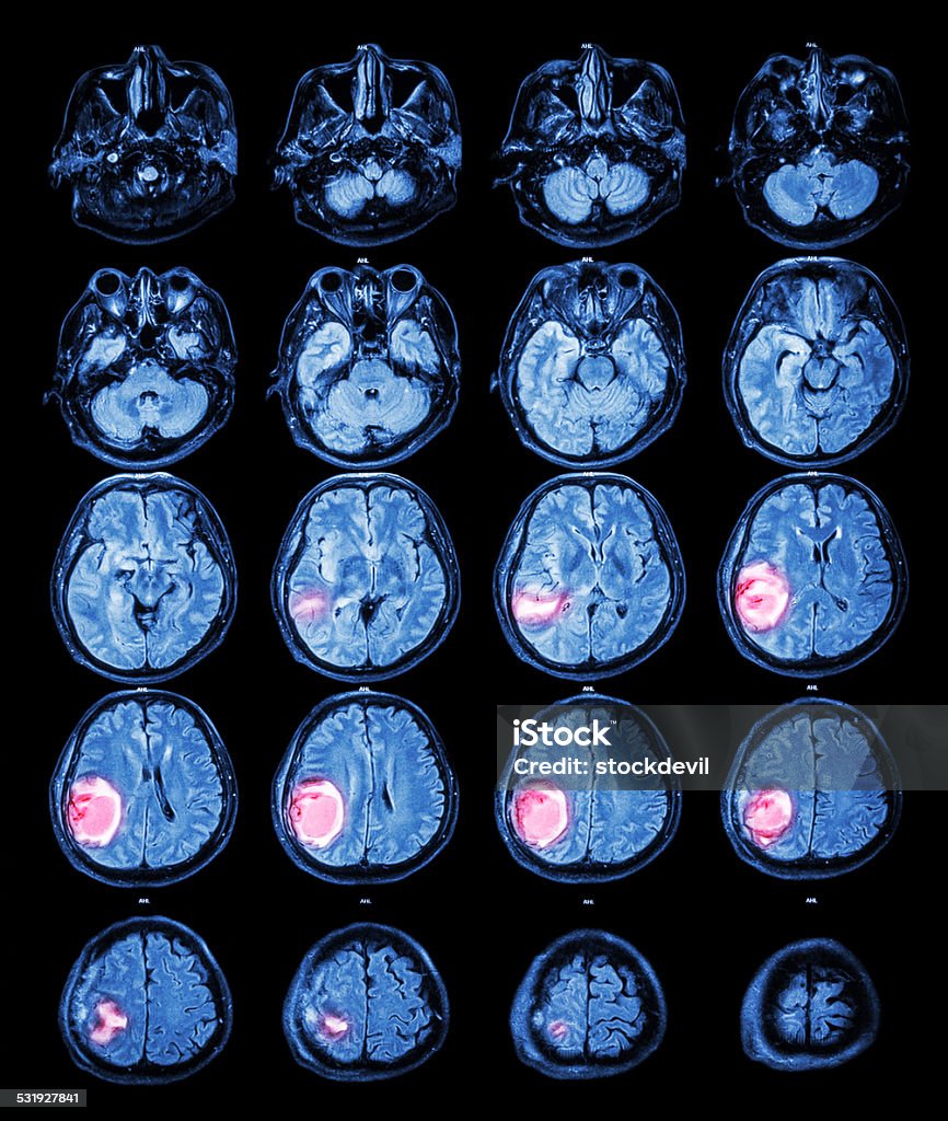 MRI brain : Brain tumor at right parietal lobe MRI Scan Stock Photo