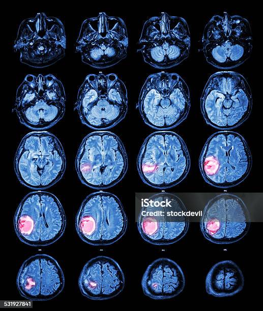 Mri Brain Brain Tumor At Right Parietal Lobe Stock Photo - Download Image Now - MRI Scan, Brain Tumour, Tumor