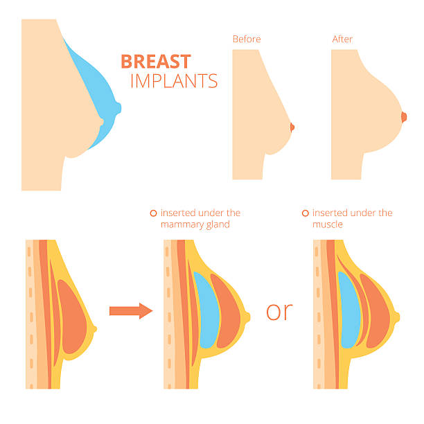 Breast augmentation infographics. Breast augmentation infographics. Breast implants vector illustration silicon stock illustrations