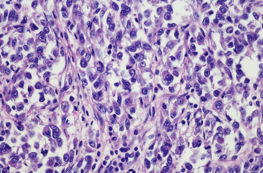 Clear cell sarcoma of the leg. Tumor cells with prominent nucleoli and clear cytoplasm are arranged in well-defined nests surrounded by dense fibrous stroma. Sarcomas are cancers that arise within connective tissues, such as bone, muscle, fat, and tendons.  Clear cell sarcoma tumors tend to grow attached to tendons in the limbs, especially in the feet and hands. H&E stain