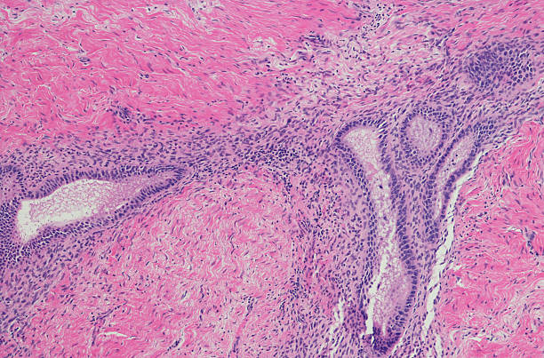 Micrograph of endometriosis Endometriosis describes a condition where pieces of womb lining tissue or endometrium are deposited outside the womb, in the pelvis or abdomen. The endometrial tissue may occur on the fallopian tubes, ovaries, peritoneum, gut, rectum or vagina. endometriosis stock pictures, royalty-free photos & images