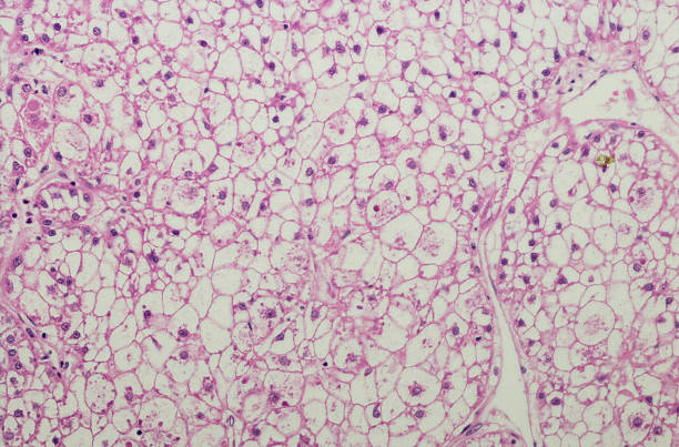 Clear cell hepatocellular carcinoma, liver carcinoma