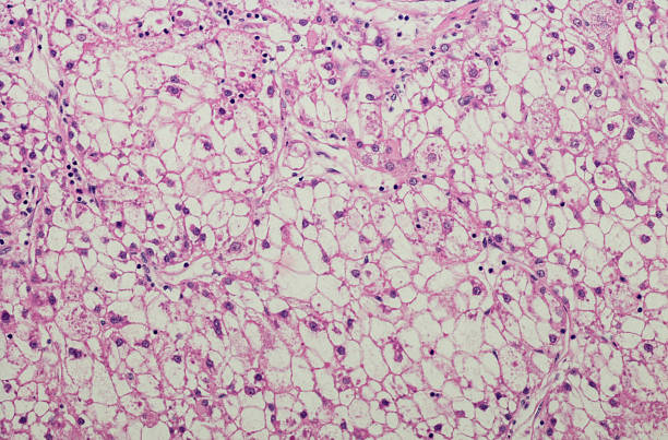istock Clear cell hepatocellular carcinoma, liver carcinoma 532030768