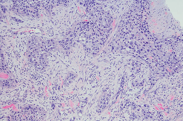 istock Invasive ductal carcinoma (breast cancer) high grade. 532031576