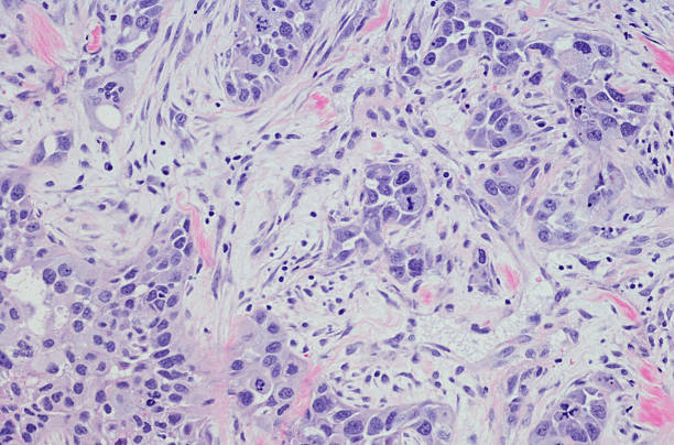 istock Invasive ductal carcinoma (breast cancer) high grade. 532031588