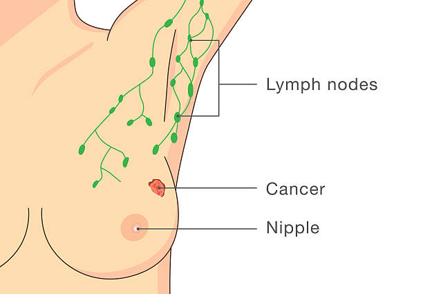 illustrazioni stock, clip art, cartoni animati e icone di tendenza di donna è stata il cancro al seno. - lymph node