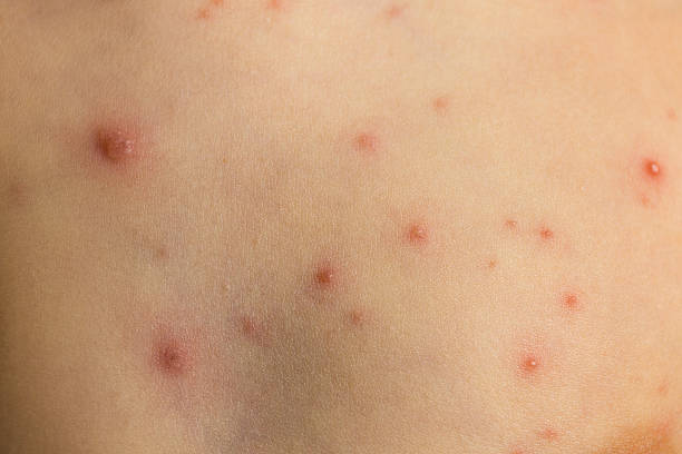 varizellen haut - chickenpox skin condition baby illness stock-fotos und bilder