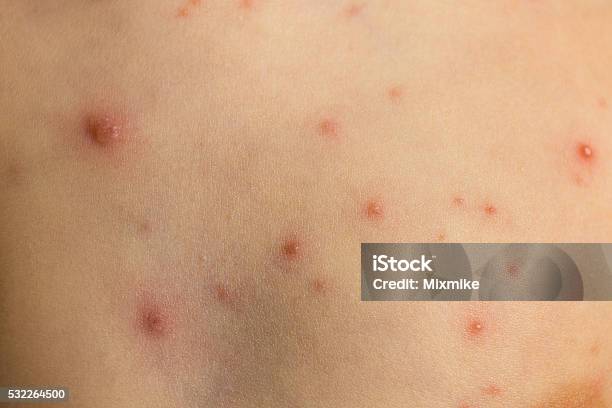 水痘 肌の質感 - 吹き出物のストックフォトや画像を多数ご用意 - 吹き出物, 不満, 帯状疱疹